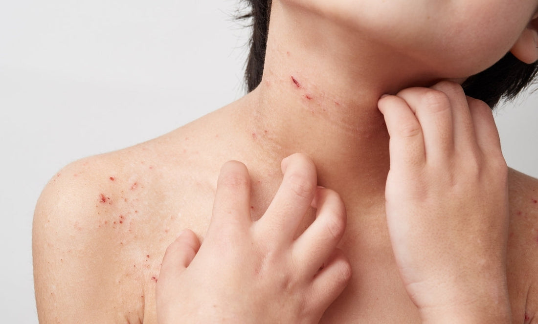 Managing Eczema & Dry Skin During Winter