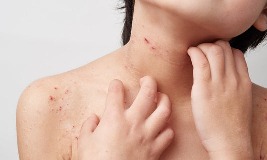 Managing Eczema & Dry Skin During Winter