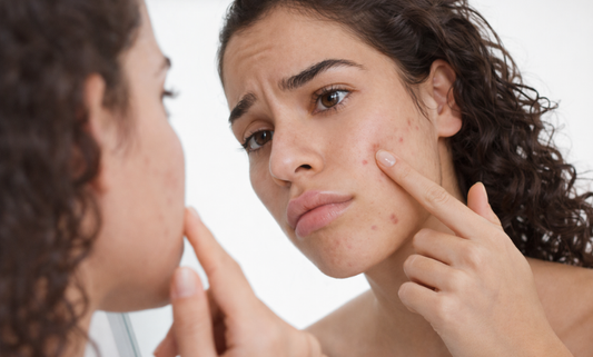 Common Skincare Mistakes That Make Acne Worse
